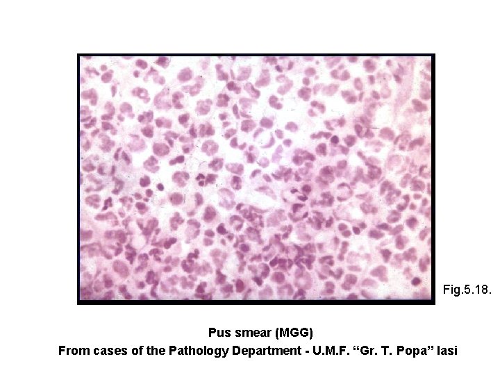 Fig. 5. 18. Pus smear (MGG) From cases of the Pathology Department - U.