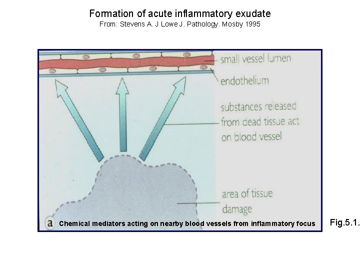 Formation of acute inflammatory exudate From: Stevens A. J Lowe J. Pathology. Mosby 1995