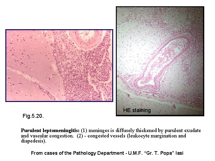 Fig. 5. 20. HE staining Purulent leptomeningitis: (1) meninges is diffusely thickened by purulent