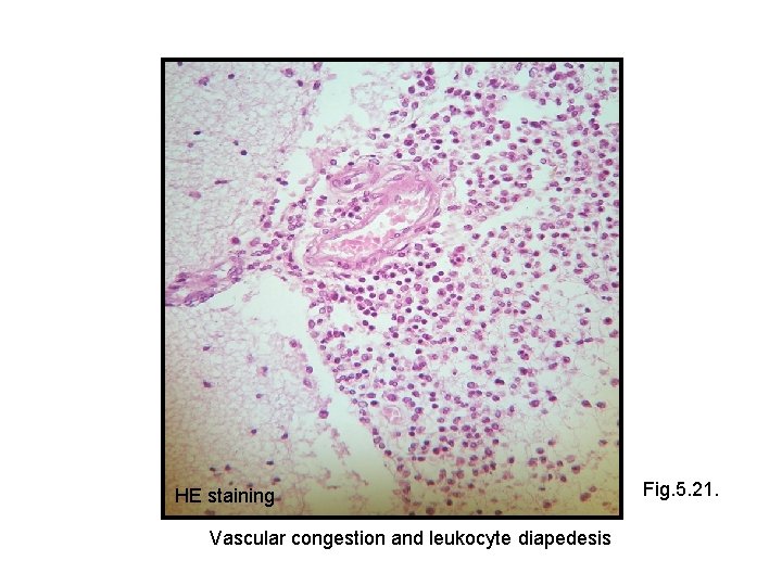 HE staining Vascular congestion and leukocyte diapedesis Fig. 5. 21. 