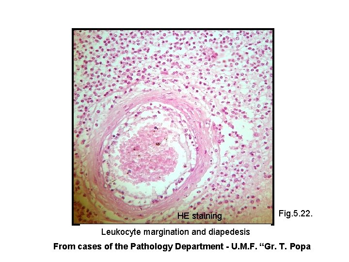 HE staining Fig. 5. 22. Leukocyte margination and diapedesis From cases of the Pathology
