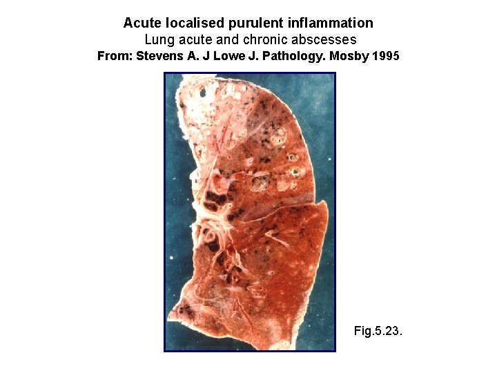 Acute localised purulent inflammation Lung acute and chronic abscesses From: Stevens A. J Lowe