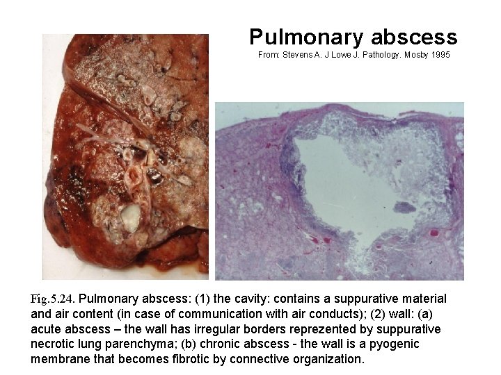 Pulmonary abscess From: Stevens A. J Lowe J. Pathology. Mosby 1995 Fig. 5. 24.