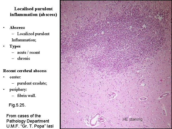 Localised purulent inflammation (abscess) • • Abscess: – Localized purulent Inflammation; Types – acute