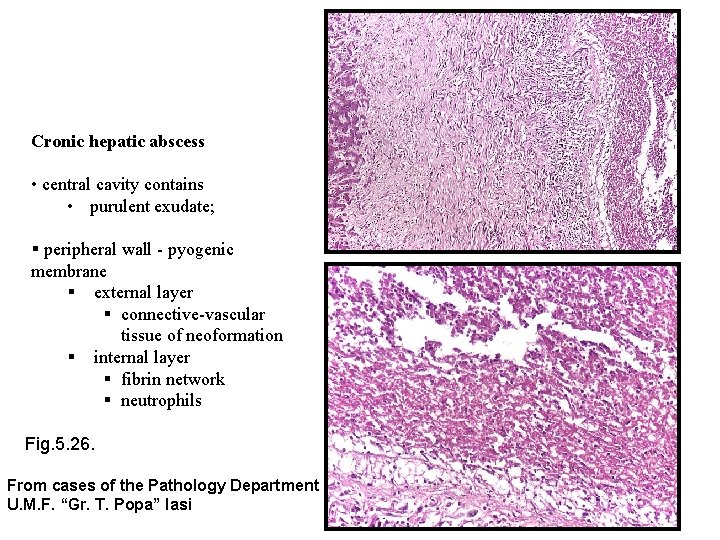 Cronic hepatic abscess • central cavity contains • purulent exudate; § peripheral wall -