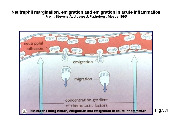 Neutrophil margination, emigration and emigration in acute inflammation From: Stevens A. J Lowe J.