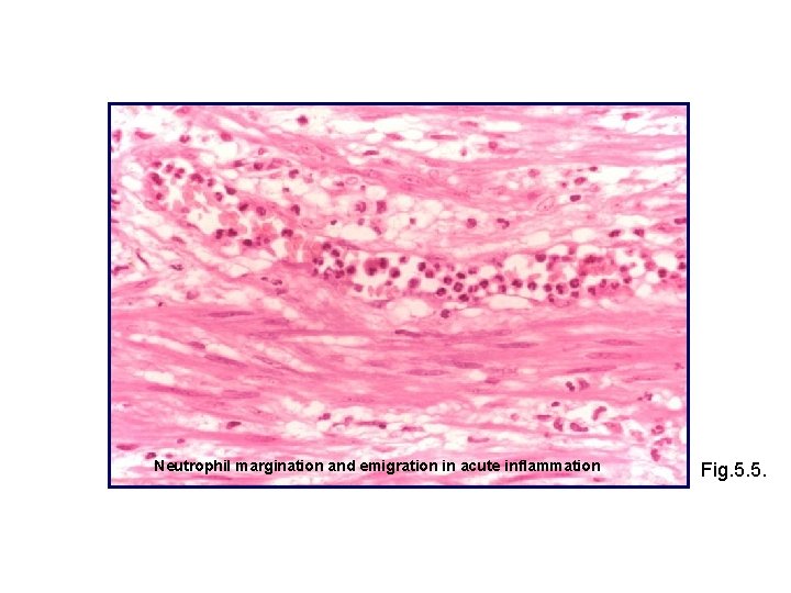 Neutrophil margination and emigration in acute inflammation Fig. 5. 5. 