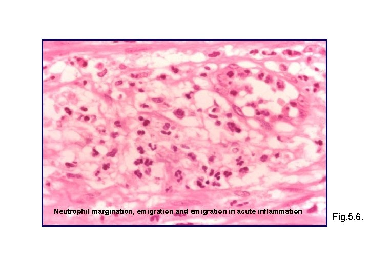 Neutrophil margination, emigration and emigration in acute inflammation Fig. 5. 6. 