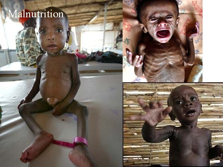 Malnutrition 