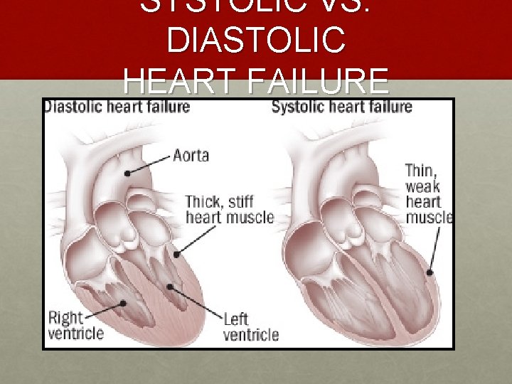 SYSTOLIC VS. DIASTOLIC HEART FAILURE 