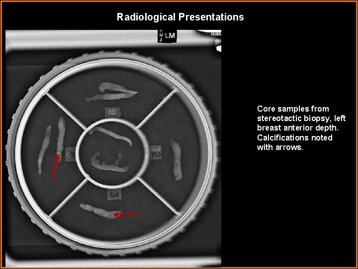 Radiological Presentations Core samples from stereotactic biopsy, left breast anterior depth. Calcifications noted with