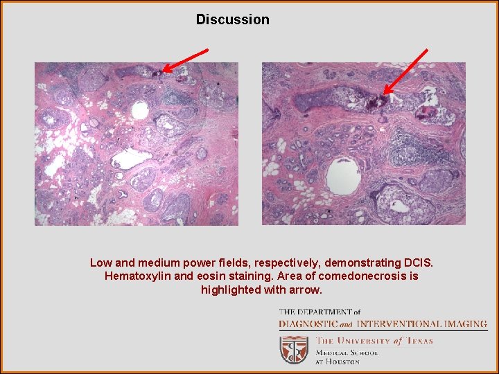 Discussion Low and medium power fields, respectively, demonstrating DCIS. Hematoxylin and eosin staining. Area