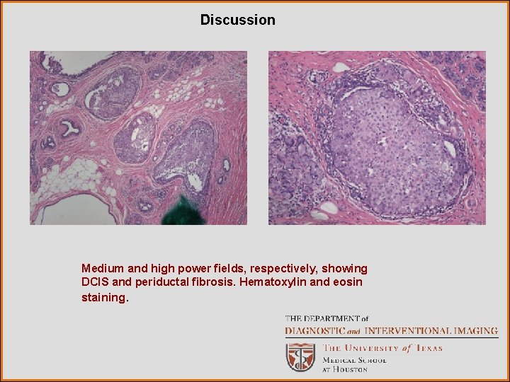 Discussion Medium and high power fields, respectively, showing DCIS and periductal fibrosis. Hematoxylin and