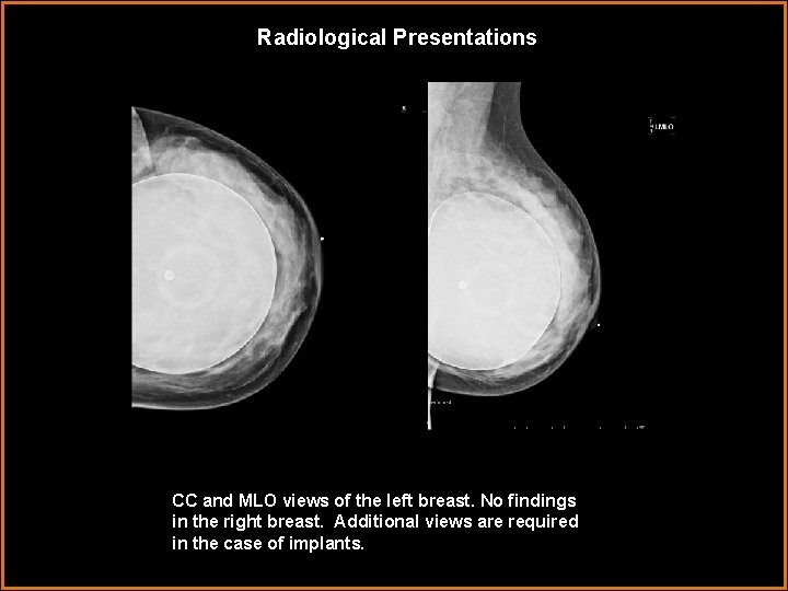 Radiological Presentations CC and MLO views of the left breast. No findings in the