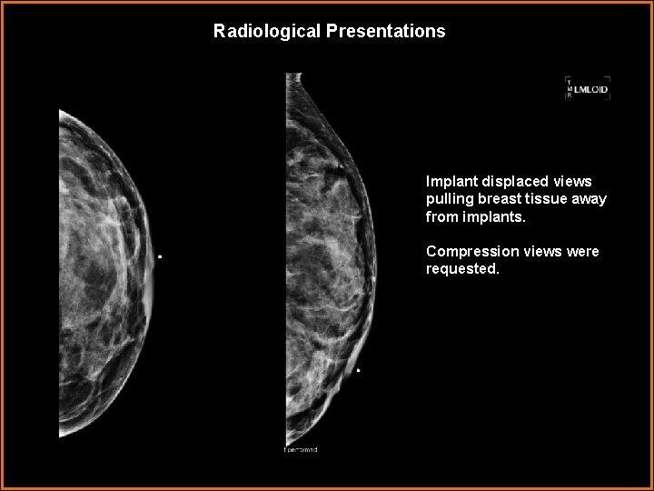 Radiological Presentations Implant displaced views pulling breast tissue away from implants. Compression views were