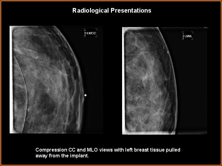 Radiological Presentations Compression CC and MLO views with left breast tissue pulled away from