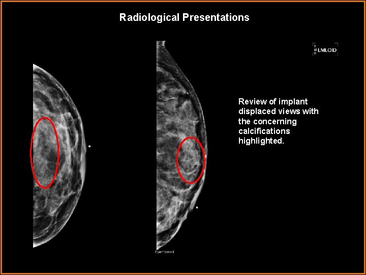 Radiological Presentations Review of implant displaced views with the concerning calcifications highlighted. 