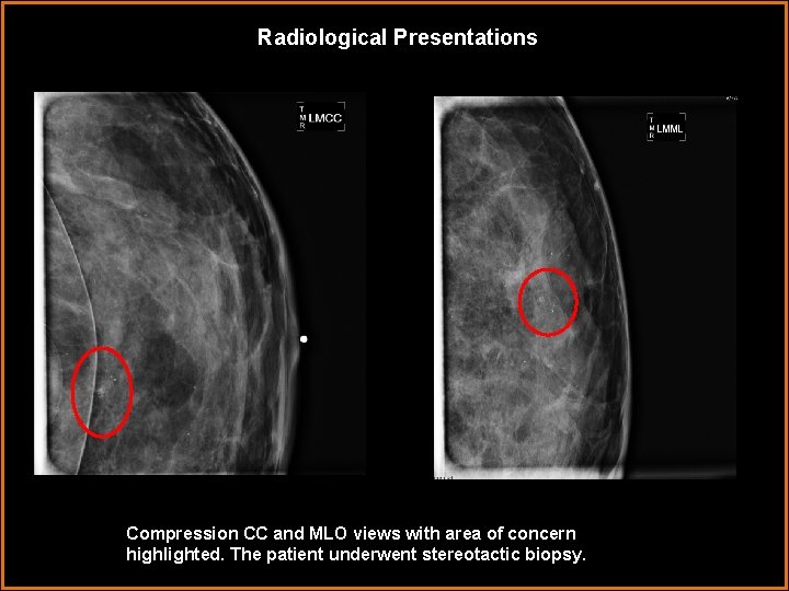 Radiological Presentations Compression CC and MLO views with area of concern highlighted. The patient