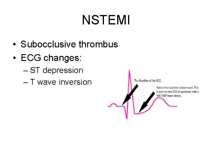 NSTEMI • Subocclusive thrombus • ECG changes: – ST depression – T wave inversion NSTEMI • Subocclusive thrombus • ECG changes: – ST depression – T wave inversion