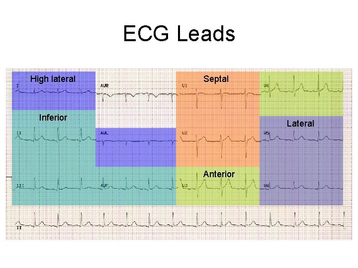 ECG Leads High lateral Septal Inferior Lateral Anterior 