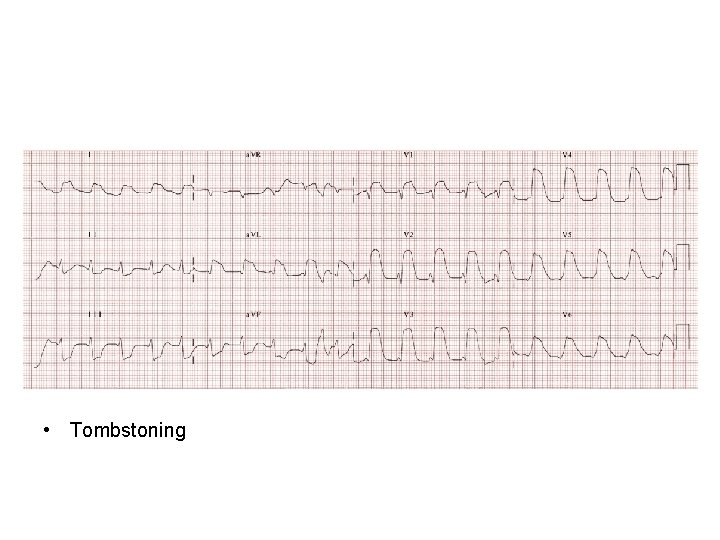 • Tombstoning • Tombstoning