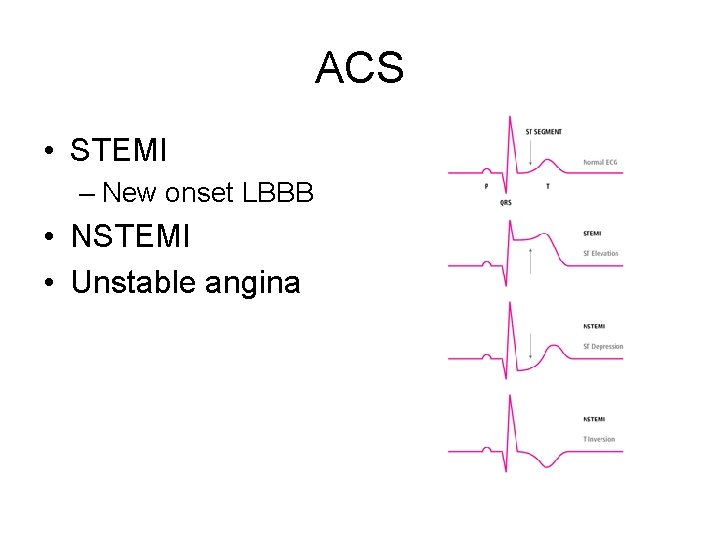 ACS • STEMI – New onset LBBB • NSTEMI • Unstable angina 