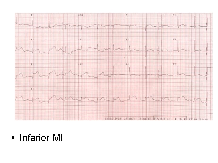 • Inferior MI • Inferior MI