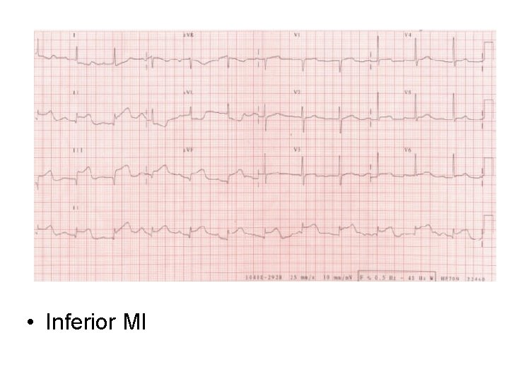  • Inferior MI 