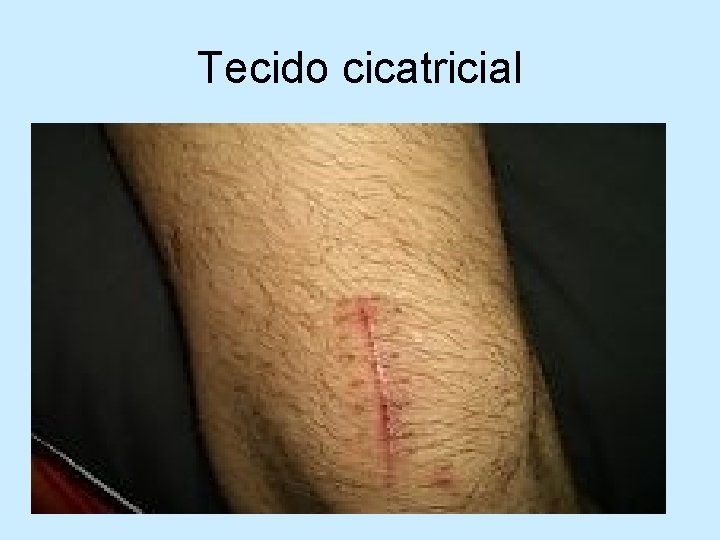 Tecido cicatricial 