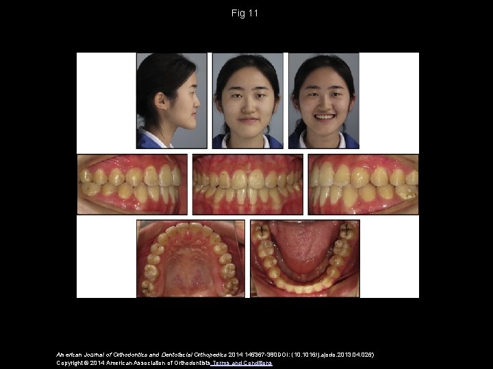 Fig 11 American Journal of Orthodontics and Dentofacial Orthopedics 2014 145367 -380 DOI: (10.