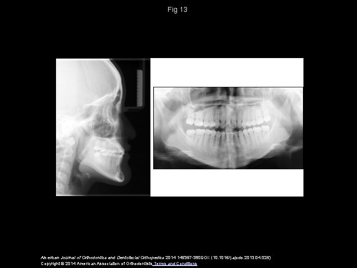 Fig 13 American Journal of Orthodontics and Dentofacial Orthopedics 2014 145367 -380 DOI: (10.