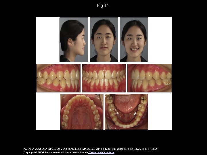 Fig 14 American Journal of Orthodontics and Dentofacial Orthopedics 2014 145367 -380 DOI: (10.