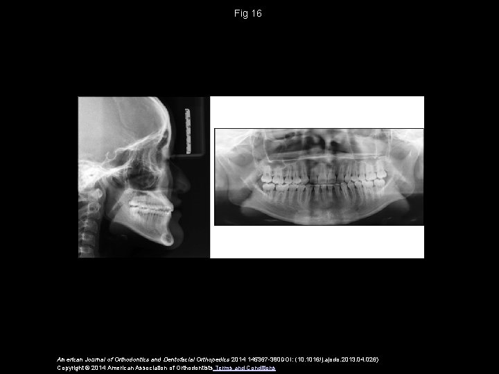 Fig 16 American Journal of Orthodontics and Dentofacial Orthopedics 2014 145367 -380 DOI: (10.