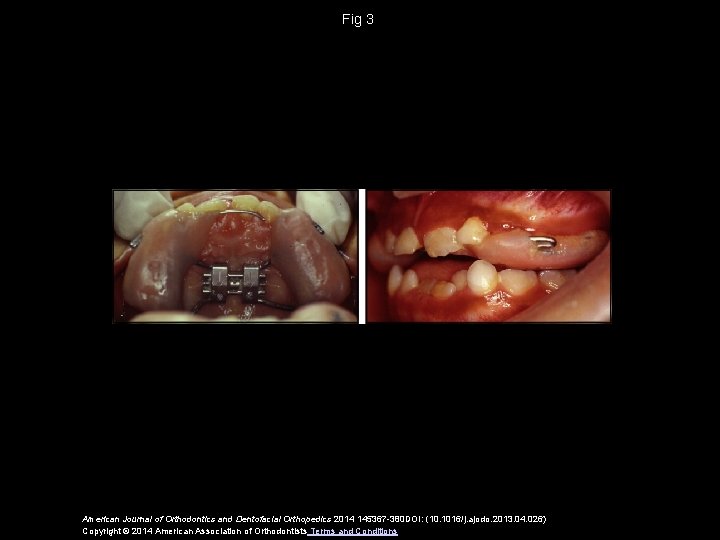 Fig 3 American Journal of Orthodontics and Dentofacial Orthopedics 2014 145367 -380 DOI: (10.