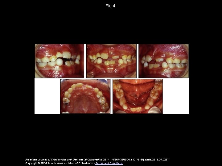 Fig 4 American Journal of Orthodontics and Dentofacial Orthopedics 2014 145367 -380 DOI: (10.