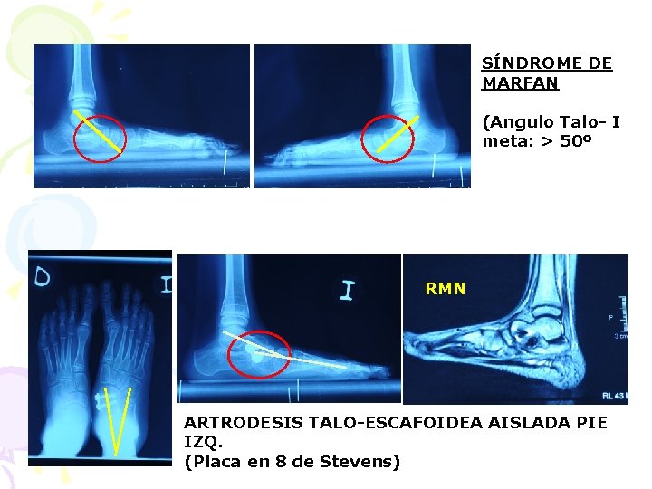 SÍNDROME DE MARFAN (Angulo Talo- I meta: > 50º RMN ARTRODESIS TALO-ESCAFOIDEA AISLADA PIE