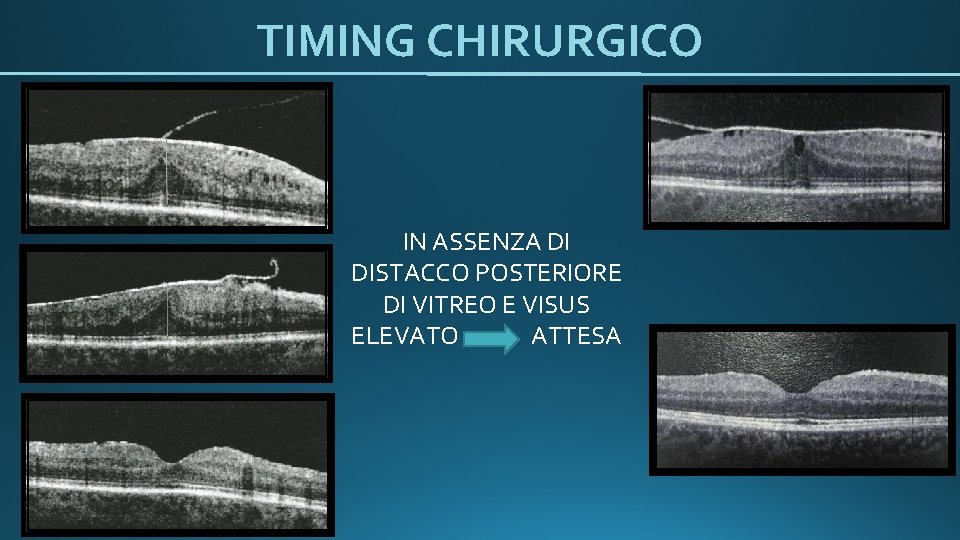 TIMING CHIRURGICO IN ASSENZA DI DISTACCO POSTERIORE DI VITREO E VISUS ELEVATO ATTESA 