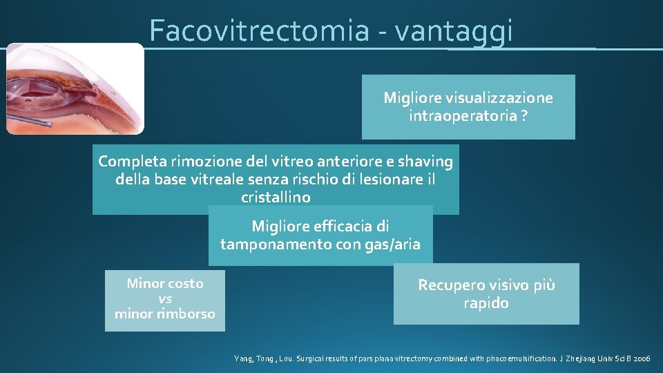 Facovitrectomia - vantaggi Migliore visualizzazione intraoperatoria ? Completa rimozione del vitreo anteriore e shaving