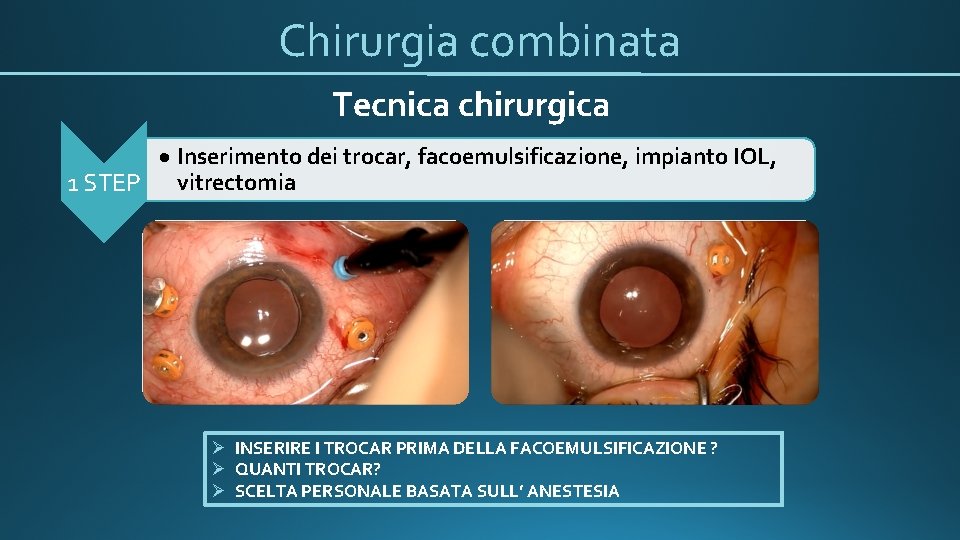 Chirurgia combinata Tecnica chirurgica Inserimento dei trocar, facoemulsificazione, impianto IOL, 1 STEP vitrectomia Ø