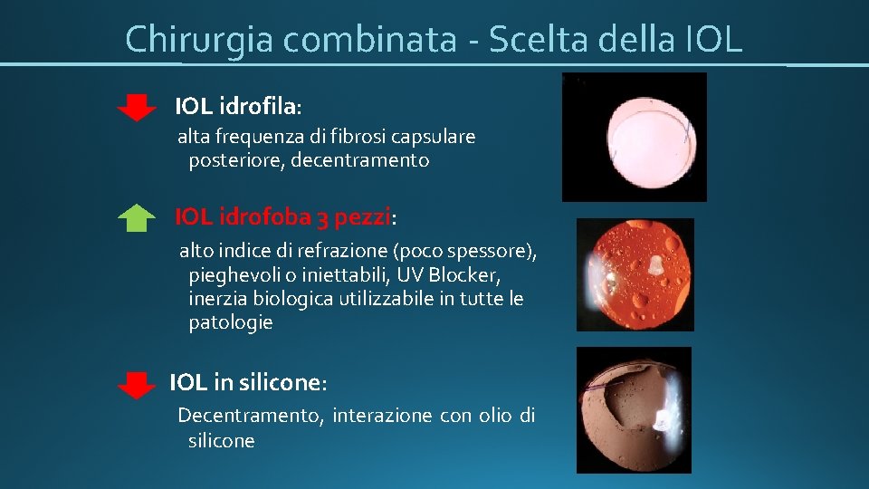 Chirurgia combinata - Scelta della IOL idrofila: alta frequenza di fibrosi capsulare posteriore, decentramento