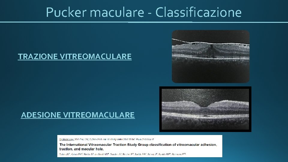 Pucker maculare - Classificazione TRAZIONE VITREOMACULARE ADESIONE VITREOMACULARE 