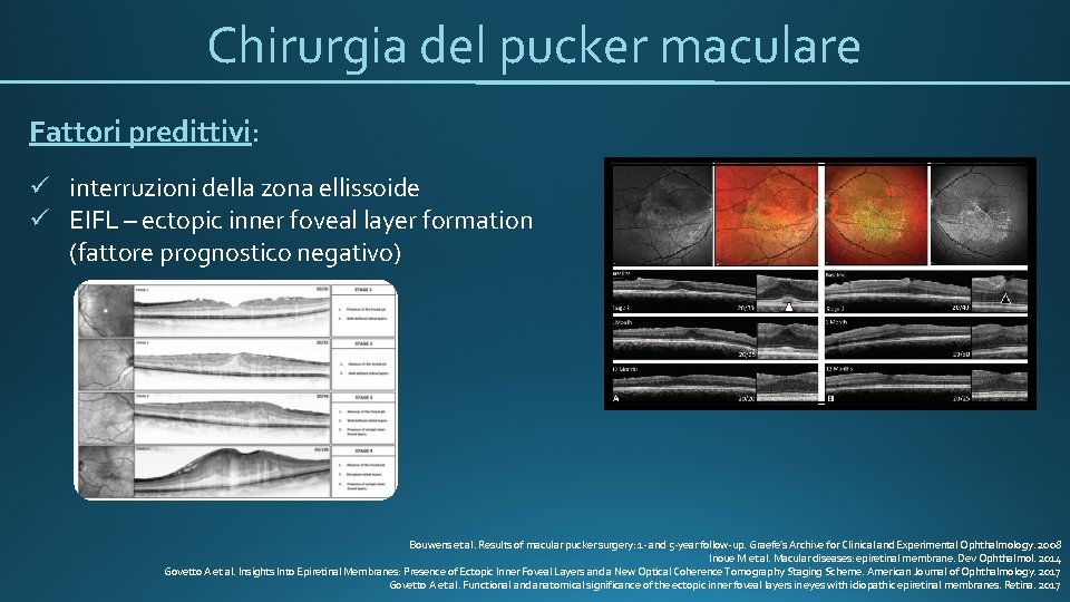 Chirurgia del pucker maculare Fattori predittivi: ü interruzioni della zona ellissoide ü EIFL –