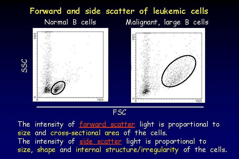 Forward and side scatter of leukemic cells Malignant, large B cells SSC Normal B