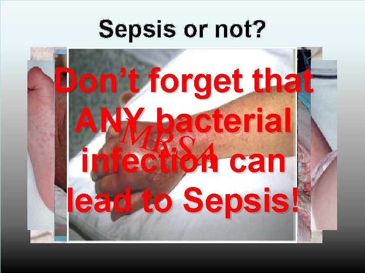 Sepsis or not? Don’t forget that Cesl. S M ANY bacterial Sleuieepn. R n.