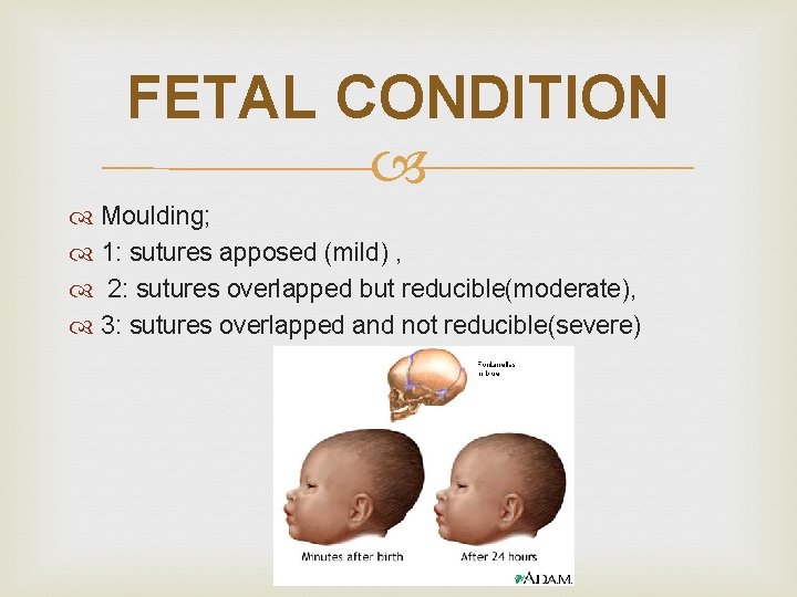 FETAL CONDITION Moulding; 1: sutures apposed (mild) , 2: sutures overlapped but reducible(moderate), 3: