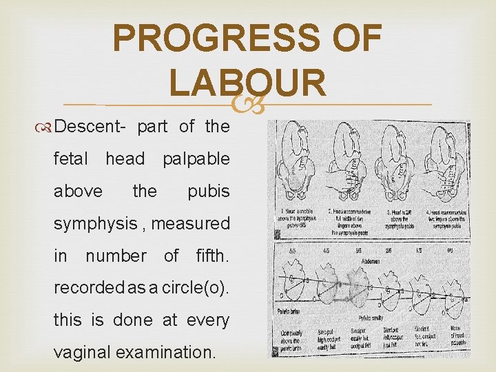 PROGRESS OF LABOUR Descent- part of the fetal head palpable above the pubis symphysis