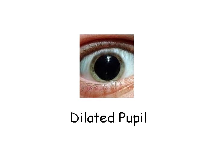 Dilated Pupil 