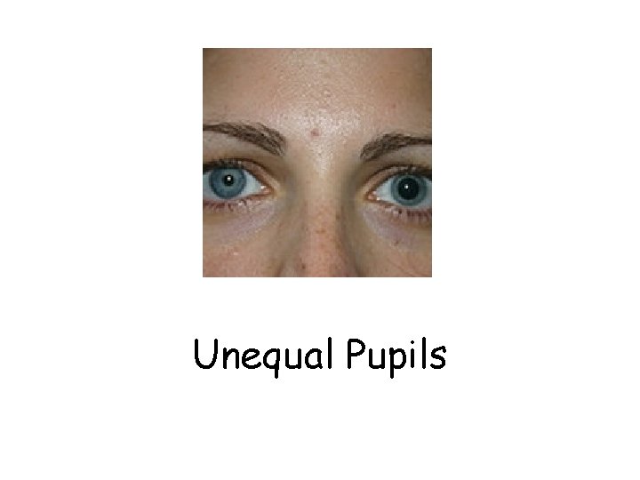 Unequal Pupils 