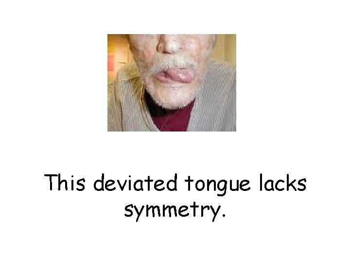 This deviated tongue lacks symmetry. 