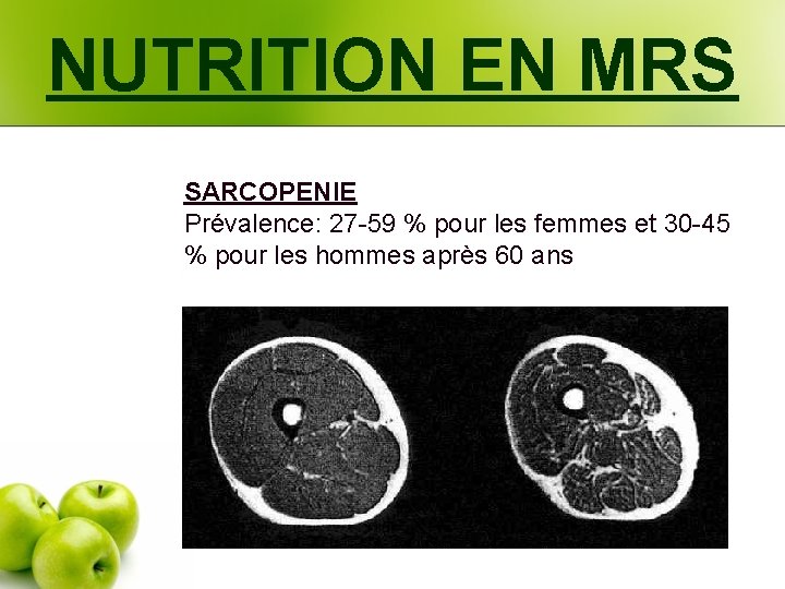 NUTRITION EN MRS SARCOPENIE Prévalence: 27 -59 % pour les femmes et 30 -45